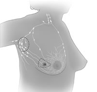 drawing of breast sparing surgery