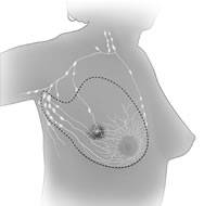 drawing of modified breast surgery